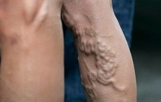 варикозное расширение вен на ногах